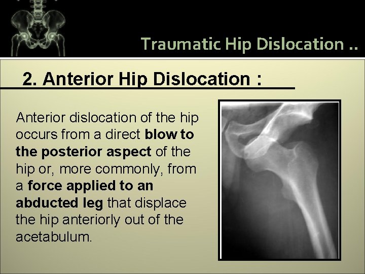 Traumatic Hip Dislocation. . 2. Anterior Hip Dislocation : Anterior dislocation of the hip