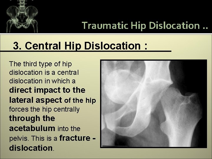 Traumatic Hip Dislocation. . 3. Central Hip Dislocation : The third type of hip