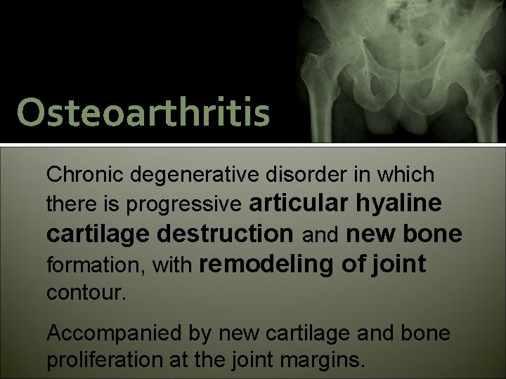 Osteoarthritis Chronic degenerative disorder in which there is progressive articular hyaline cartilage destruction and
