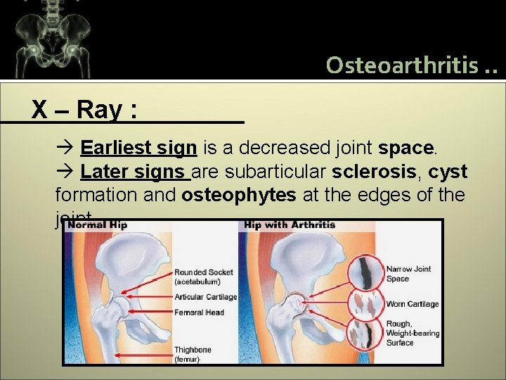 Osteoarthritis. . X – Ray : Earliest sign is a decreased joint space. Later