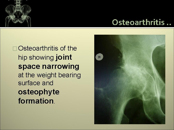 Osteoarthritis. . � Osteoarthritis of the hip showing joint space narrowing at the weight