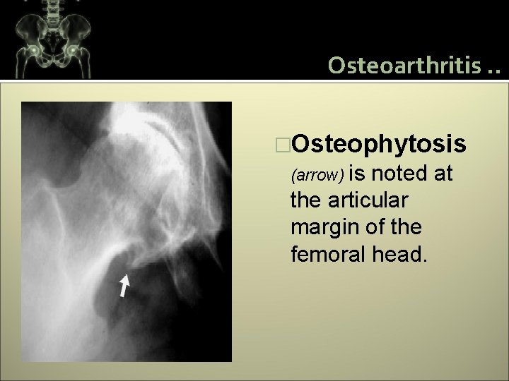 Osteoarthritis. . �Osteophytosis (arrow) is noted at the articular margin of the femoral head.