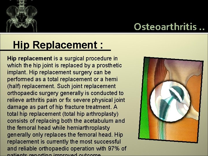 Osteoarthritis. . Hip Replacement : Hip replacement is a surgical procedure in which the