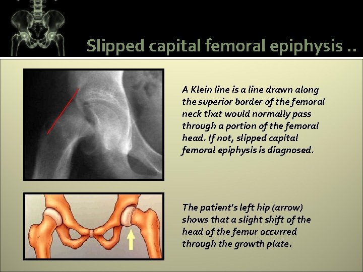 Slipped capital femoral epiphysis. . A Klein line is a line drawn along the