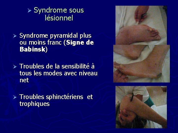 Ø Syndrome sous lésionnel Ø Syndrome pyramidal plus ou moins franc (Signe de Babinsk)