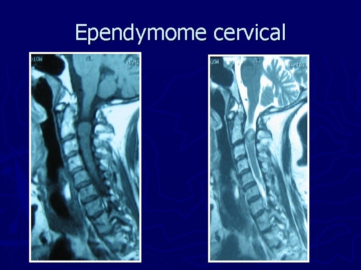 Ependymome cervical 