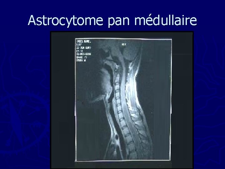 Astrocytome pan médullaire 