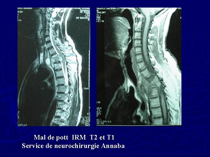 Mal de pott IRM T 2 et T 1 Service de neurochirurgie Annaba 