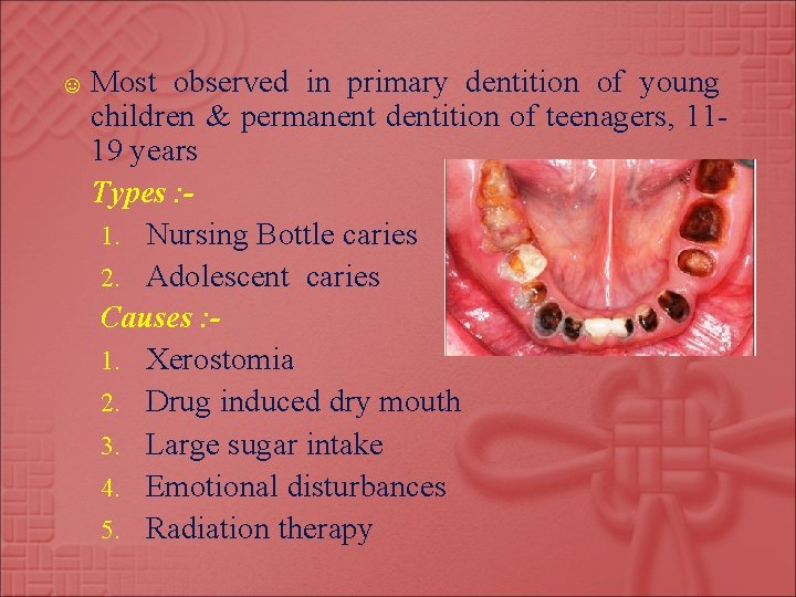 ☺ Most observed in primary dentition of young children & permanent dentition of teenagers,