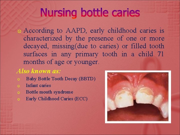 Nursing bottle caries ☺ According to AAPD, early childhood caries is characterized by the