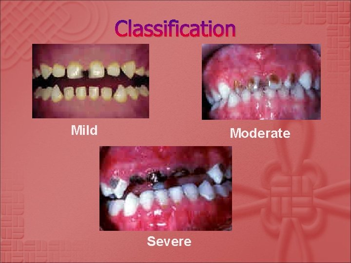 Classification Mild Moderate Severe 