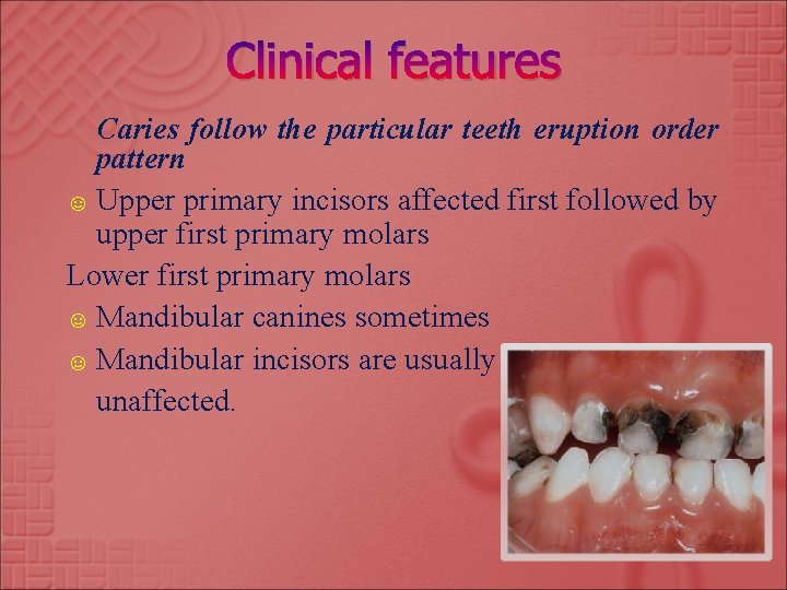 Clinical features Caries follow the particular teeth eruption order pattern ☺ Upper primary incisors