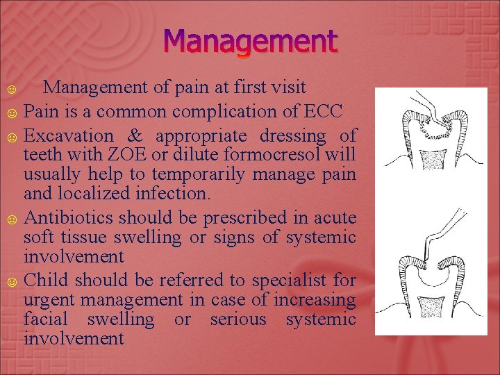 Management of pain at first visit ☺ Pain is a common complication of ECC