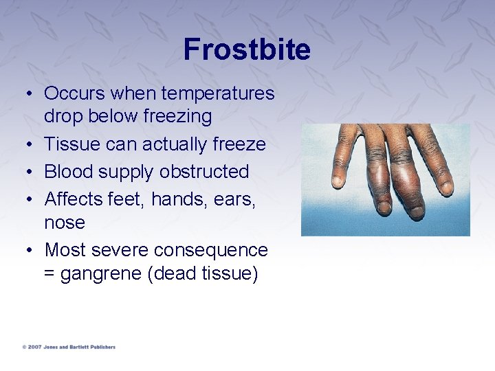 Frostbite • Occurs when temperatures drop below freezing • Tissue can actually freeze •