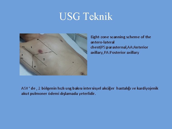 USG Teknik Eight-zone scanning scheme of the antero-lateral chest(PS: parasternal, AA: Anterior axillary, PA: