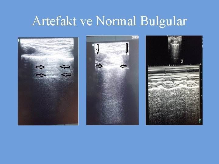 Artefakt ve Normal Bulgular 