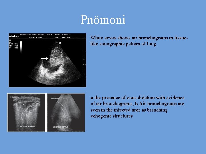 Pnömoni White arrow shows air bronchograms in tissuelike sonographic pattern of lung a the