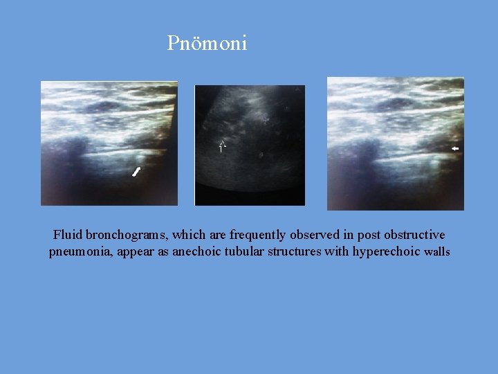 Pnömoni Fluid bronchograms, which are frequently observed in post obstructive pneumonia, appear as anechoic