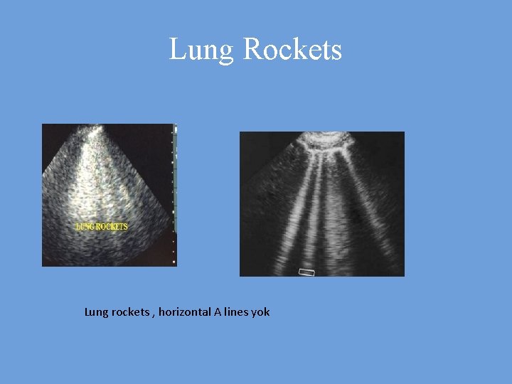 Lung Rockets Lung rockets , horizontal A lines yok 