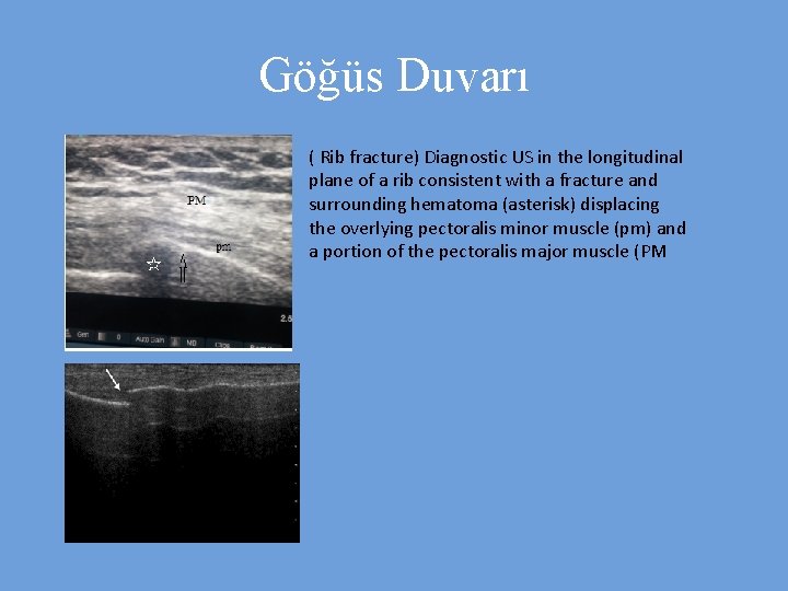 Göğüs Duvarı ( Rib fracture) Diagnostic US in the longitudinal plane of a rib