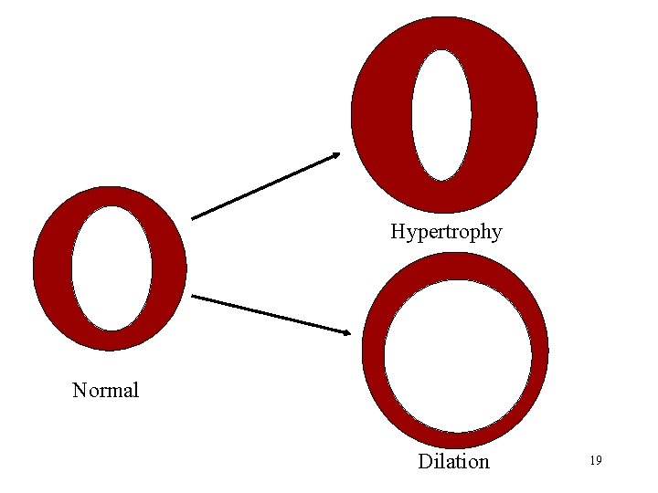 Hypertrophy Normal Dilation 19 