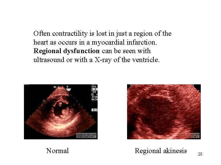 Often contractility is lost in just a region of the heart as occurs in
