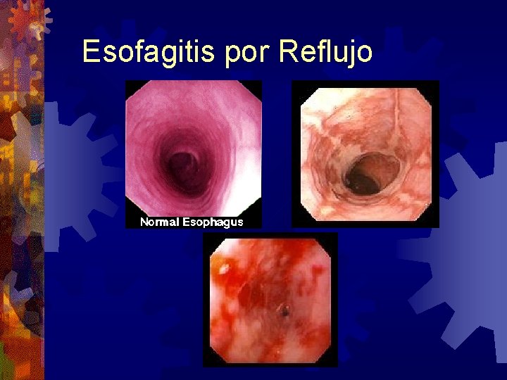 Esofagitis por Reflujo 