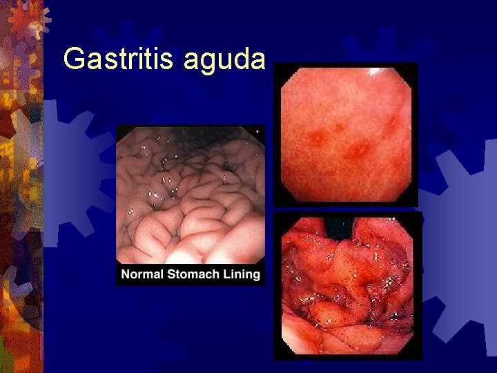 Gastritis aguda 