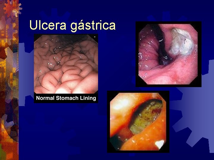 Ulcera gástrica 