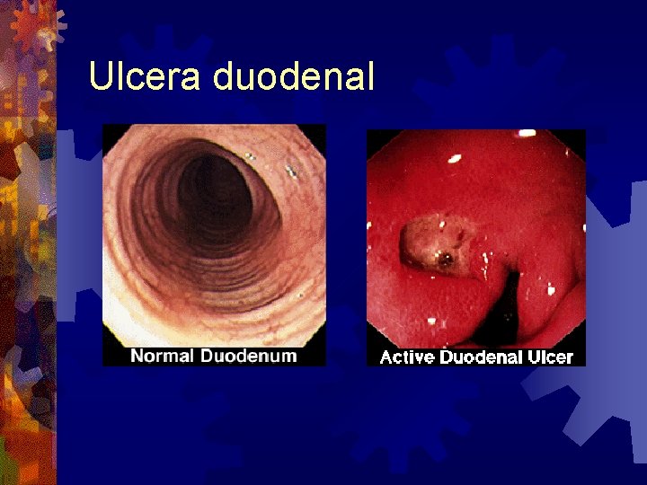 Ulcera duodenal 