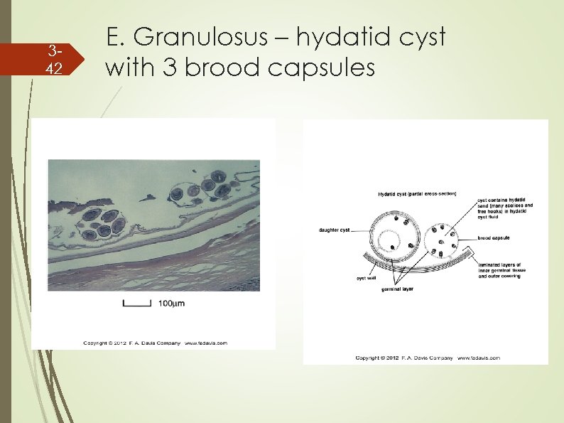 342 E. Granulosus – hydatid cyst with 3 brood capsules 