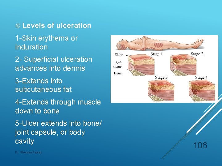  Levels of ulceration 1 -Skin erythema or induration 2 - Superficial ulceration advances