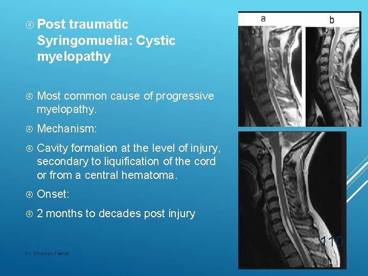  Post traumatic Syringomuelia: Cystic myelopathy Most common cause of progressive myelopathy. Mechanism: Cavity