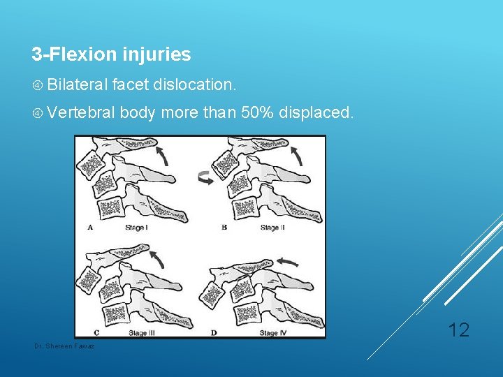 3 -Flexion injuries Bilateral facet dislocation. Vertebral body more than 50% displaced. 12 Dr.