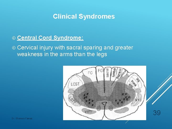 Clinical Syndromes Central Cord Syndrome: Cervical injury with sacral sparing and greater weakness in