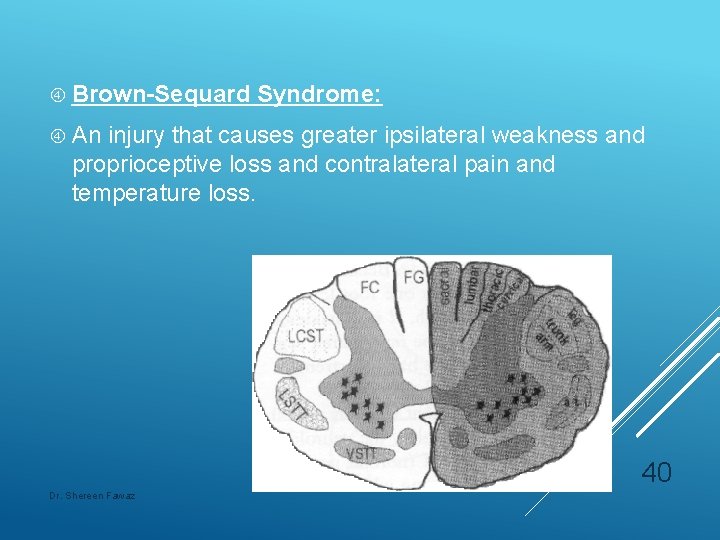  Brown-Sequard Syndrome: An injury that causes greater ipsilateral weakness and proprioceptive loss and