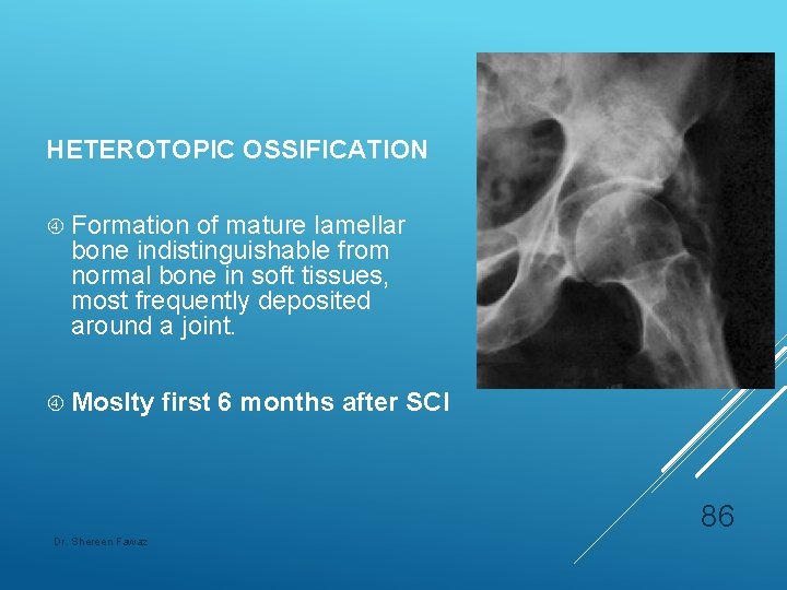 HETEROTOPIC OSSIFICATION Formation of mature lamellar bone indistinguishable from normal bone in soft tissues,