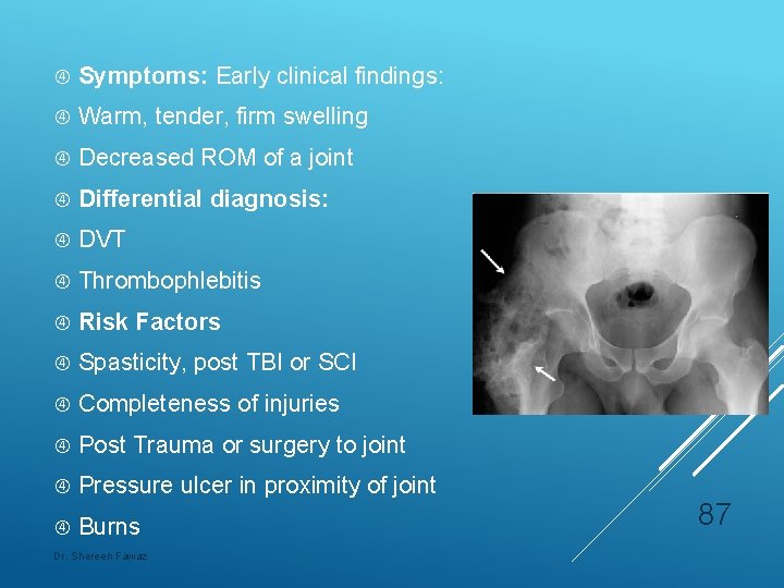  Symptoms: Early clinical findings: Warm, tender, firm swelling Decreased ROM of a joint