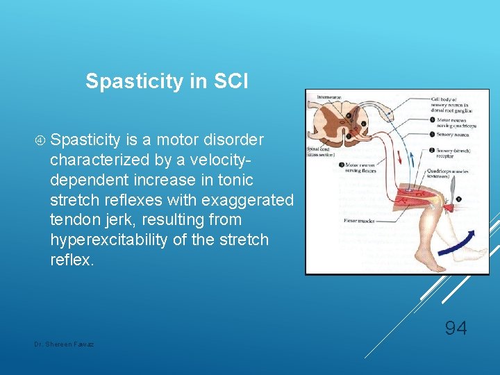 Spasticity in SCI Spasticity is a motor disorder characterized by a velocitydependent increase in