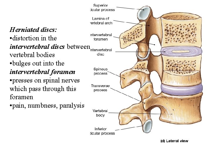 Herniated discs: • distortion in the intervertebral discs between vertebral bodies • bulges out