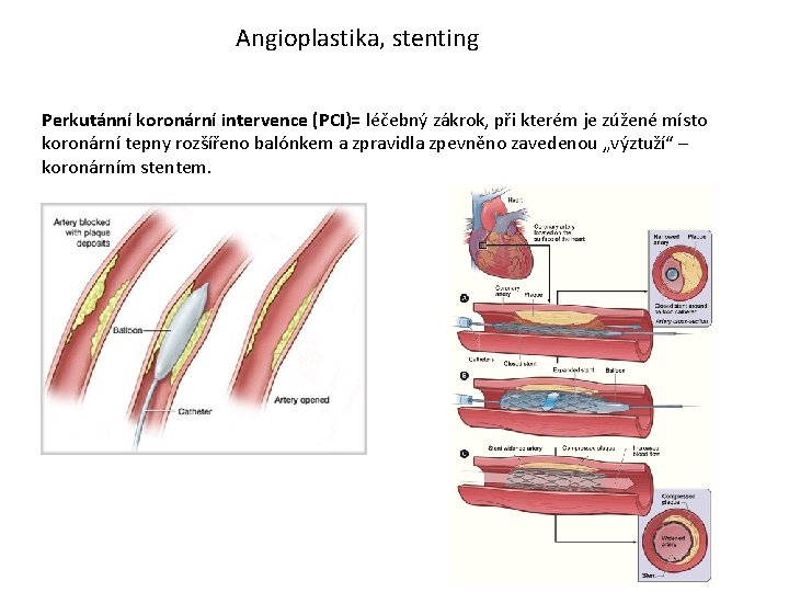 Angioplastika, stenting Perkutánní koronární intervence (PCI)= léčebný zákrok, při kterém je zúžené místo koronární