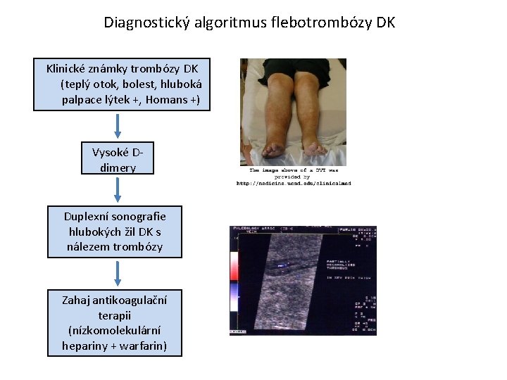 Diagnostický algoritmus flebotrombózy DK Klinické známky trombózy DK (teplý otok, bolest, hluboká palpace lýtek
