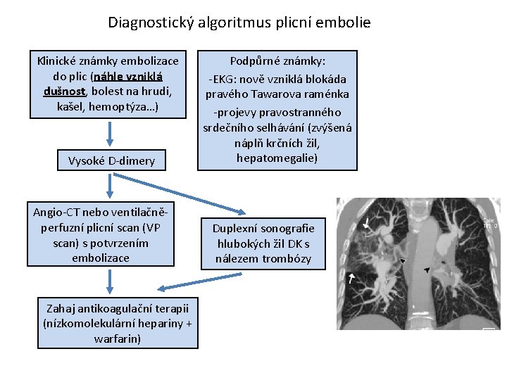 Diagnostický algoritmus plicní embolie Klinické známky embolizace do plic (náhle vzniklá dušnost, bolest na
