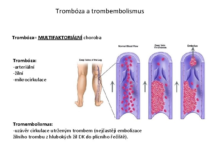 Trombóza a trombembolismus Trombóza= MULTIFAKTORIÁLNÍ choroba Trombóza: -arteriální -žilní -mikrocirkulace Tromembolismus: -uzávěr cirkulace utrženým