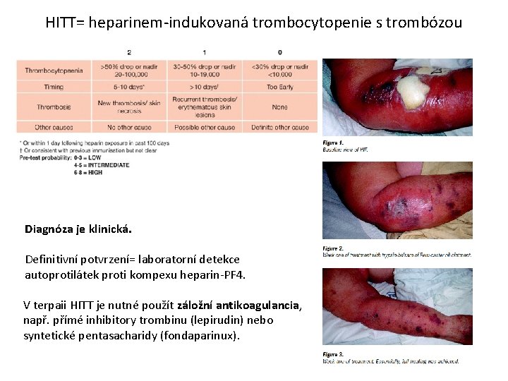 HITT= heparinem-indukovaná trombocytopenie s trombózou Diagnóza je klinická. Definitivní potvrzení= laboratorní detekce autoprotilátek proti
