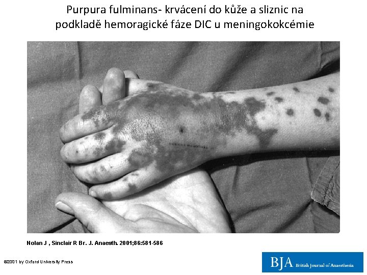 Purpura fulminans- krvácení do kůže a sliznic na podkladě hemoragické fáze DIC u meningokokcémie