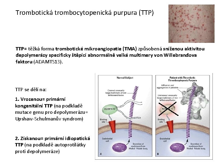 Trombotická trombocytopenická purpura (TTP) TTP= těžká forma trombotické mikroangiopatie (TMA) způsobená sníženou aktivitou depolymerázy