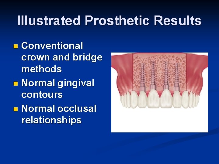 Illustrated Prosthetic Results Conventional crown and bridge methods n Normal gingival contours n Normal