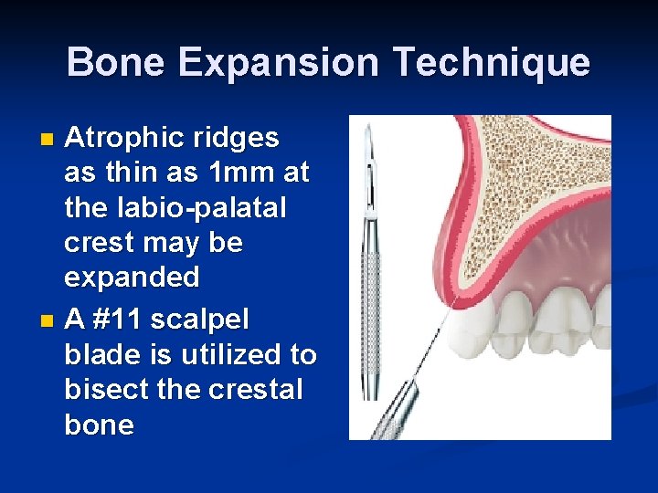 Bone Expansion Technique Atrophic ridges as thin as 1 mm at the labio-palatal crest