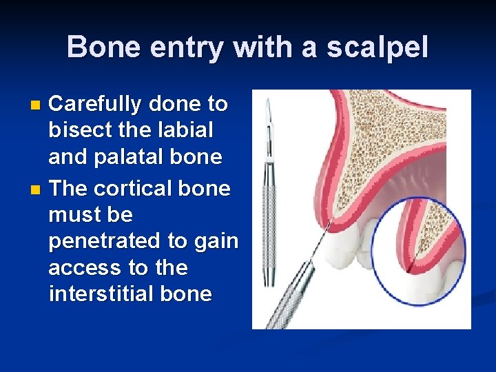 Bone entry with a scalpel Carefully done to bisect the labial and palatal bone